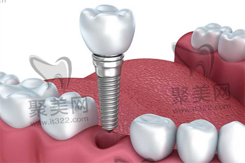 种植牙 种植牙