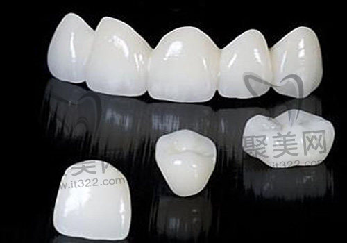 牙贴面 牙贴面