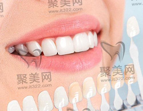 牙贴面 牙贴面