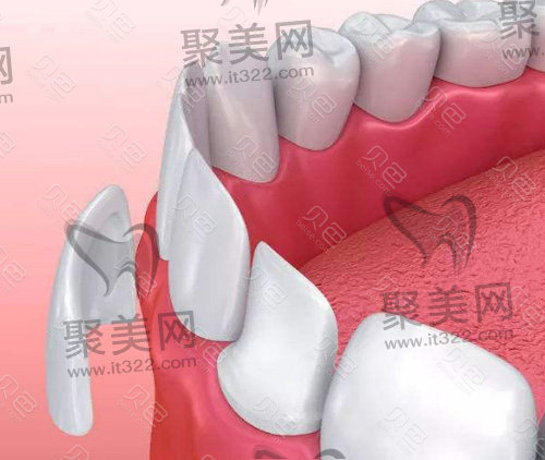 牙贴面 牙贴面