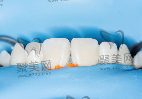 牙贴面 牙贴面