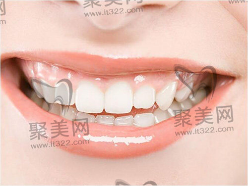 牙贴面 牙贴面