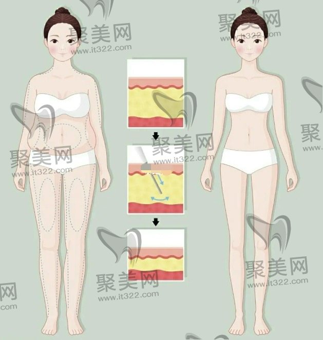 全身吸脂 全身吸脂