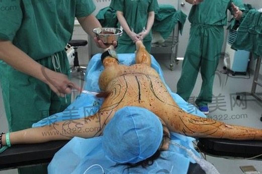 吸脂手术过程 吸脂手术过程
