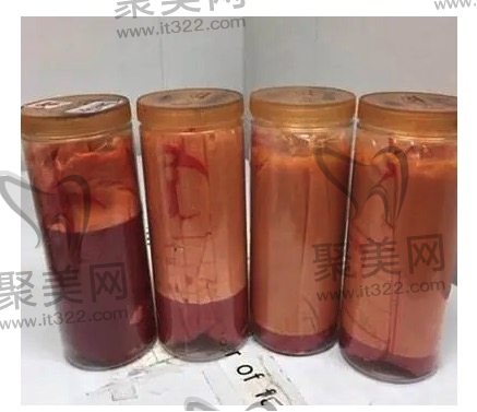 吸脂抽取出的脂肪 吸脂抽取出的脂肪