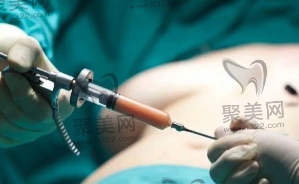 单部位吸脂 单部位吸脂