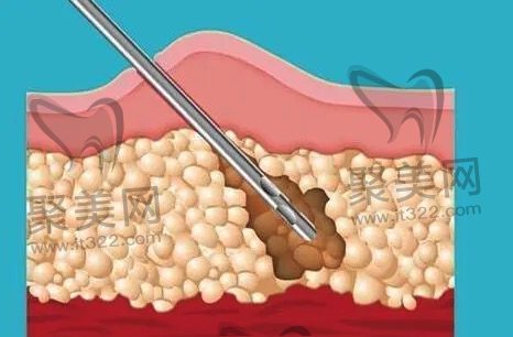全身吸脂多久能恢复正常? 全身吸脂多久能恢复正常?