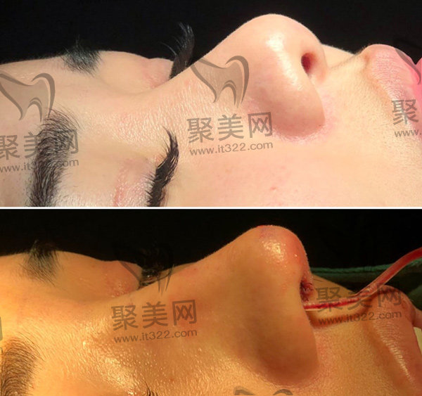 李鸿君医生鼻子实例 李鸿君医生鼻子实例