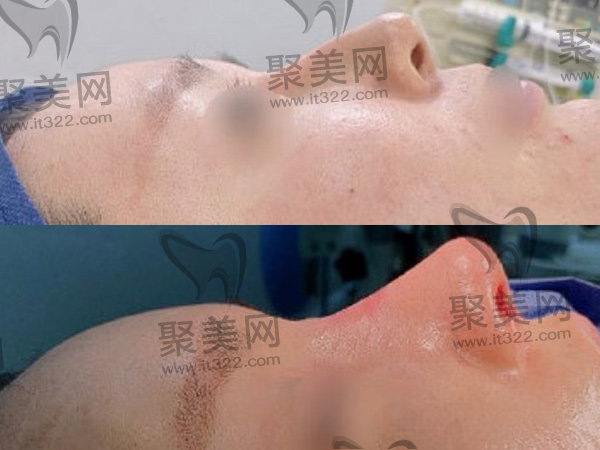 李鸿君医生鼻子实例 李鸿君医生鼻子实例