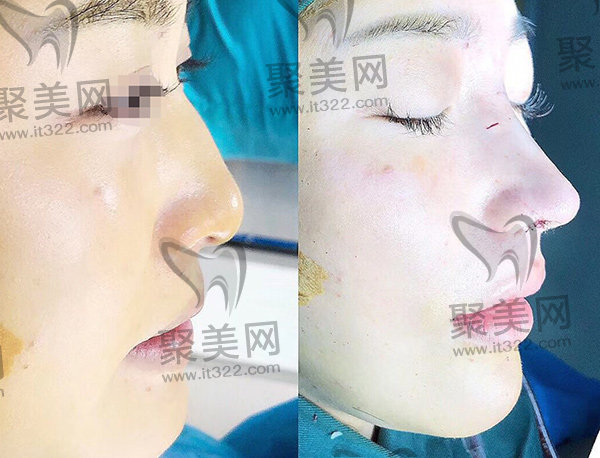 李鸿君医生鼻子实例口碑评价高 李鸿君医生鼻子实例口碑评价高