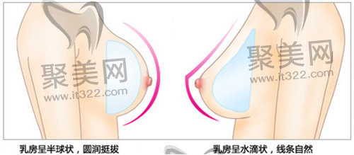 假体隆胸 假体隆胸