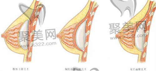 假体隆胸 假体隆胸