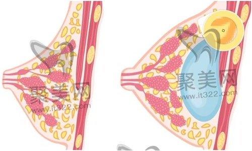 假体隆胸 假体隆胸