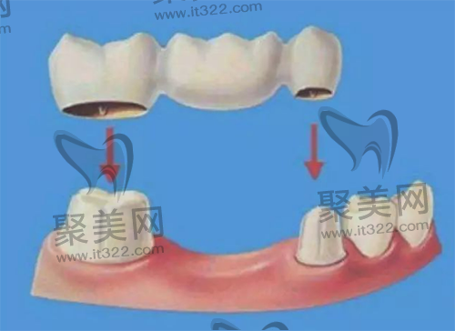 固定义齿修复 固定义齿修复