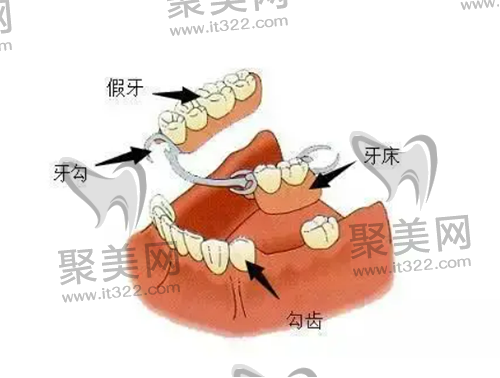 活动义齿修复 活动义齿修复