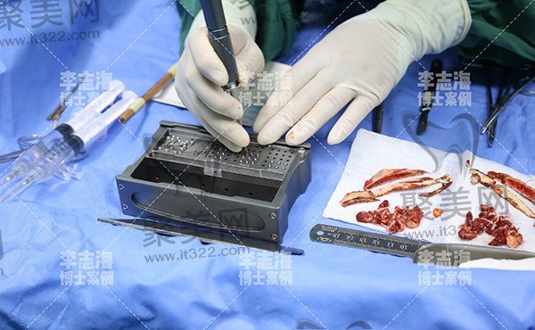 李志海磨骨手术好 李志海磨骨手术好