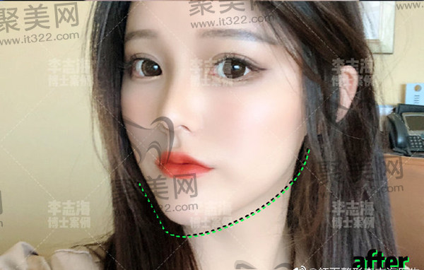 李志海磨骨成效好,手术成功且病例很惊艳 李志海磨骨成效好,手术成功且病例很惊艳