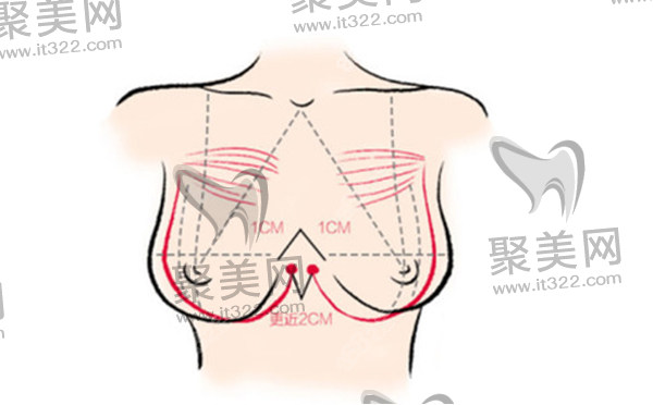 谢卫国院长做胸的技术特点 谢卫国院长做胸的技术特点