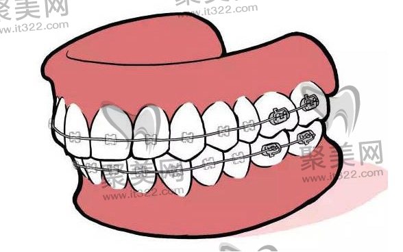 牙齿矫正老了以后就会后悔这是真的吗? 牙齿矫正老了以后就会后悔这是真的吗?