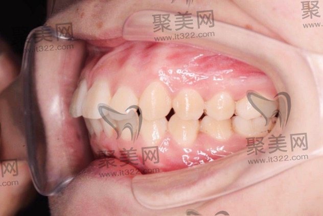 公办医院为什么不建议正畸? 公办医院为什么不建议正畸?