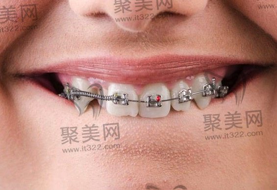 后悔做牙齿矫正了 后悔做牙齿矫正了