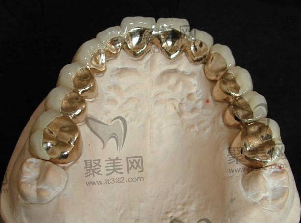 金属全口假牙 金属全口假牙