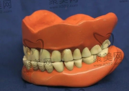 树脂全口假牙 树脂全口假牙