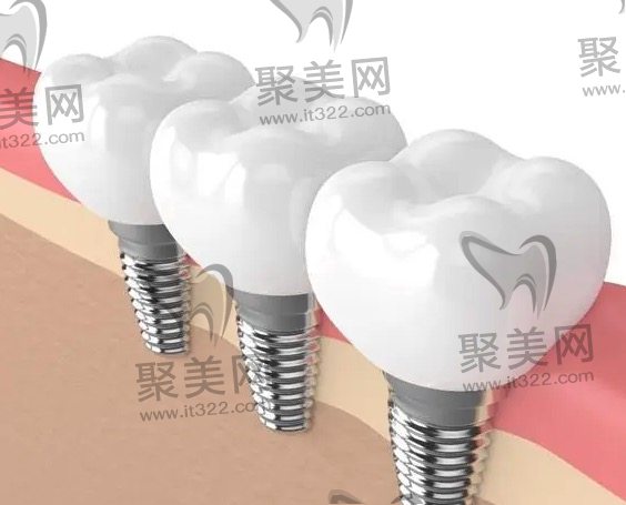 正规医院种植牙费用明细 正规医院种植牙费用明细