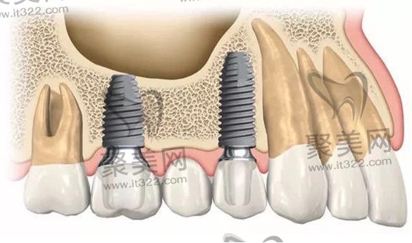如何选择正规医院进行种植牙治疗 如何选择正规医院进行种植牙治疗