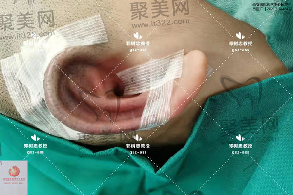 西安国 际医学郭树忠再造耳技术 西安国 际医学郭树忠再造耳技术