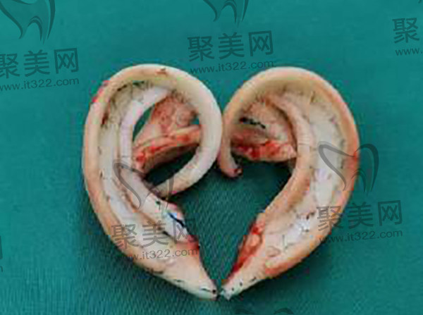 西安国 际医学郭树忠再造耳技术 西安国 际医学郭树忠再造耳技术