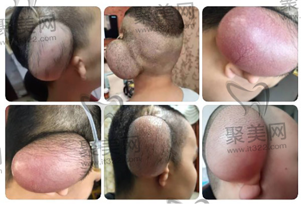 西安国 际医学郭树忠再造耳成效怎么样 西安国 际医学郭树忠再造耳成效怎么样