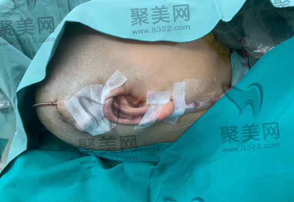 西安国 际医学郭树忠再造耳成效怎么样 西安国 际医学郭树忠再造耳成效怎么样