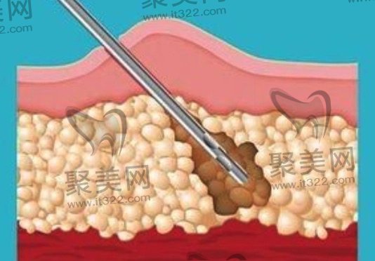 吸脂手术 吸脂手术
