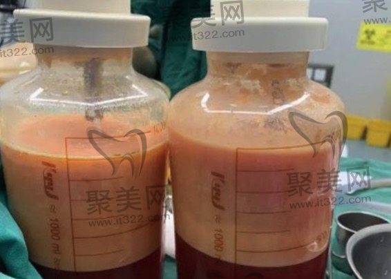 抽脂肪20斤一般多少钱? 抽脂肪20斤一般多少钱?