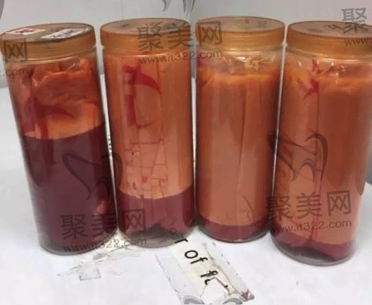 抽脂有害吗 抽脂有害吗