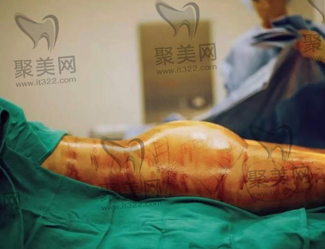 真人抽脂实例 真人抽脂实例