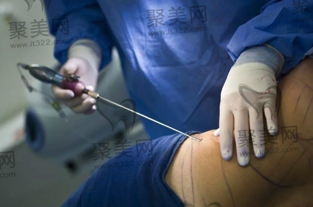 腰腹环吸好不好 腰腹环吸好不好