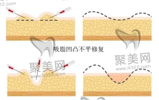 影响腰腹环吸价格的因素有哪些? 影响腰腹环吸价格的因素有哪些?