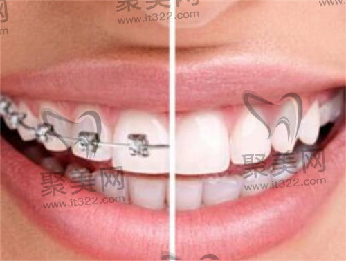 牙齿矫正 牙齿矫正