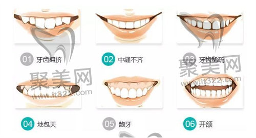 牙齿矫正 牙齿矫正