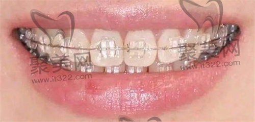 牙齿矫正 牙齿矫正