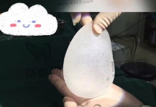 进口曼托水滴隆胸的价格 进口曼托水滴隆胸的价格