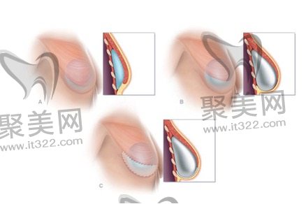 做曼托隆胸花了2万3算贵吗? 做曼托隆胸花了2万3算贵吗?