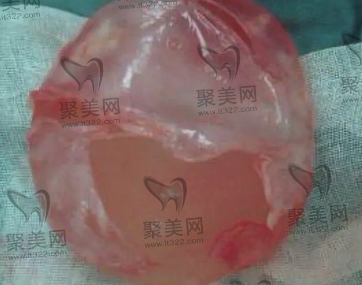 正规医院假体隆胸价格一般费用是多少钱? 正规医院假体隆胸价格一般费用是多少钱?