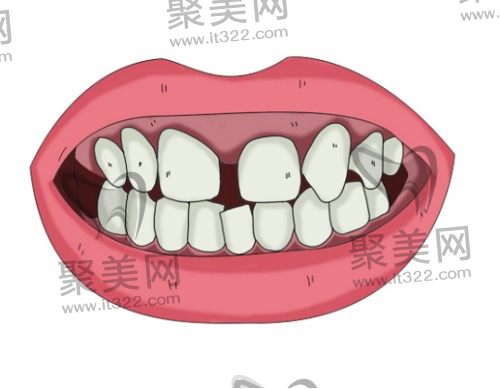 牙缝大能不能做牙齿贴面 牙缝大能不能做牙齿贴面