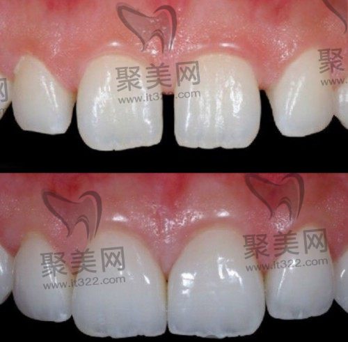门牙缝隙大做牙齿贴面好不好 门牙缝隙大做牙齿贴面好不好