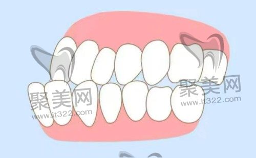 地包天能做牙齿贴面吗 地包天能做牙齿贴面吗
