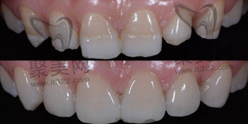 牙齿贴面的使用寿命有多久 牙齿贴面的使用寿命有多久