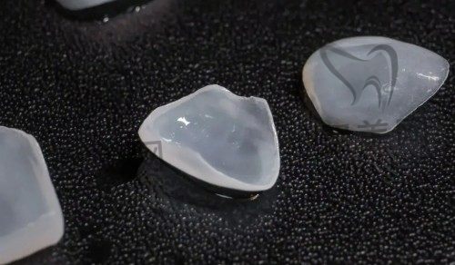 全瓷贴面 全瓷贴面